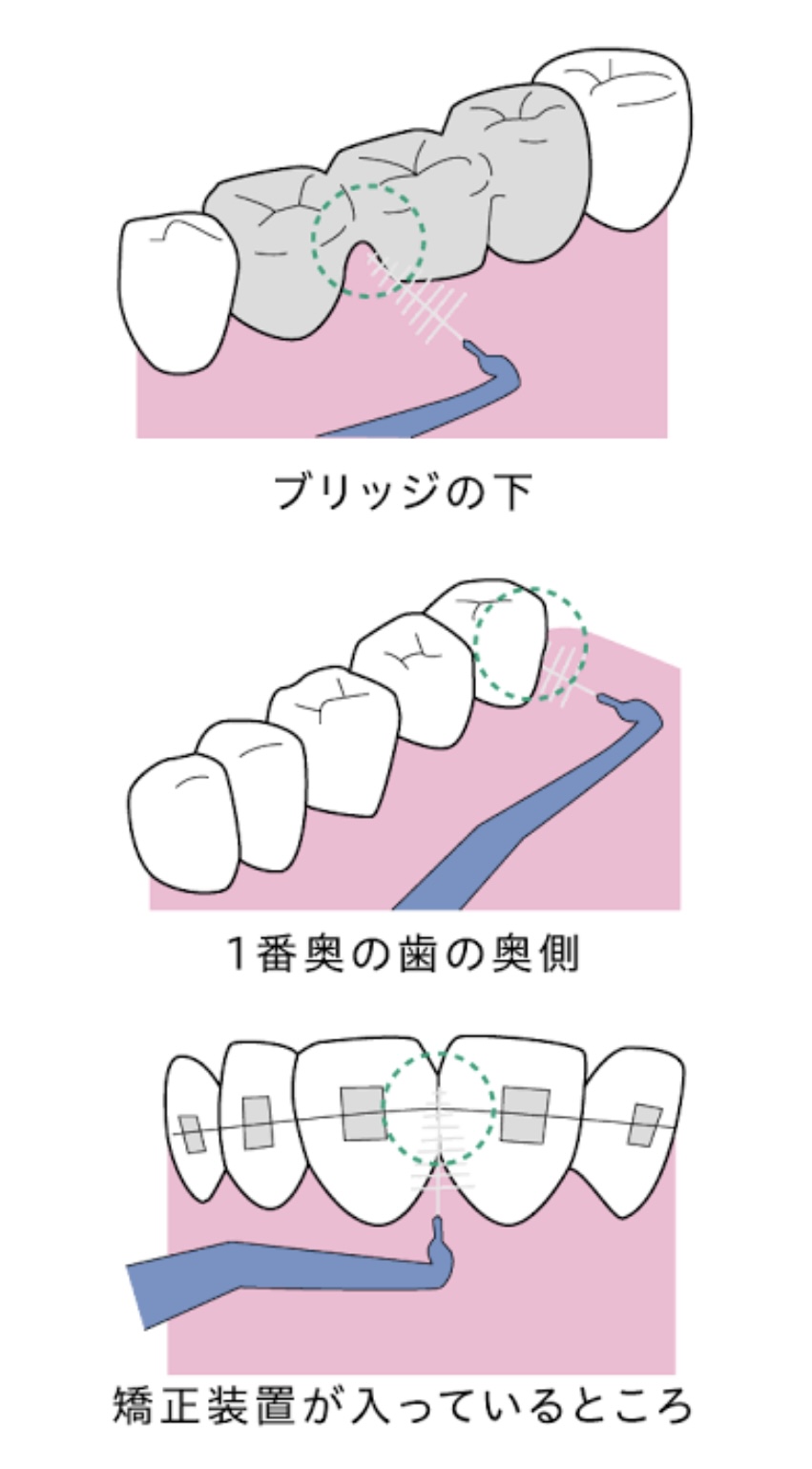 歯間ブラシをご存知ですか？