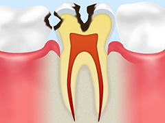 C2　象牙質まで達した虫歯