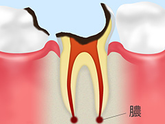 C4　末期の虫歯