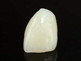 歯の冷凍保存・移植