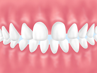 「歯と歯の間に隙間がある、すきっ歯が気になる」という方には…